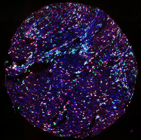 TMA_of_CRC_stained_with_UltiMapper_IO_MDSC_kit.jpg